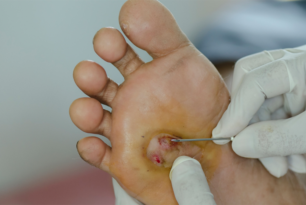 Diabetic Foot Care